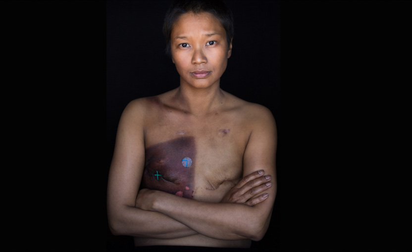 A female breast cancer patient photographed as part of Facing Chemo - reveals radiation burns and scars following a double mastectomy